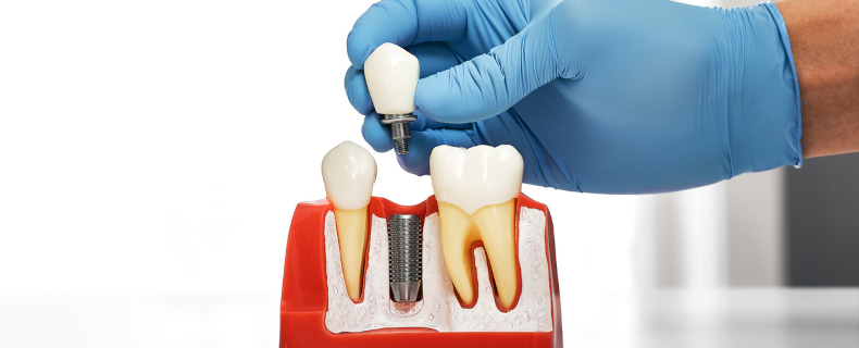 dental implants missing